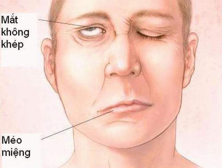 Bài thuốc hỗ trợ chữa liệt dây thần kinh VII 1