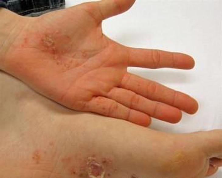 Thuốc điều trị viêm da tiếp xúc 2