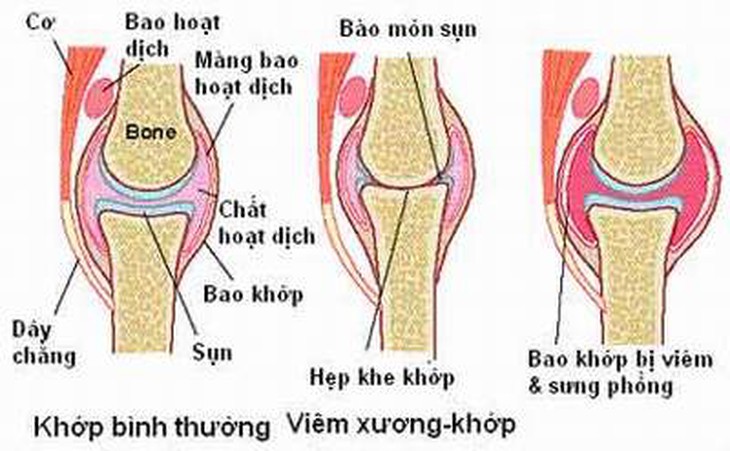 Lưu ý khi dùng thuốc trị viêm khớp dạng thấp 1