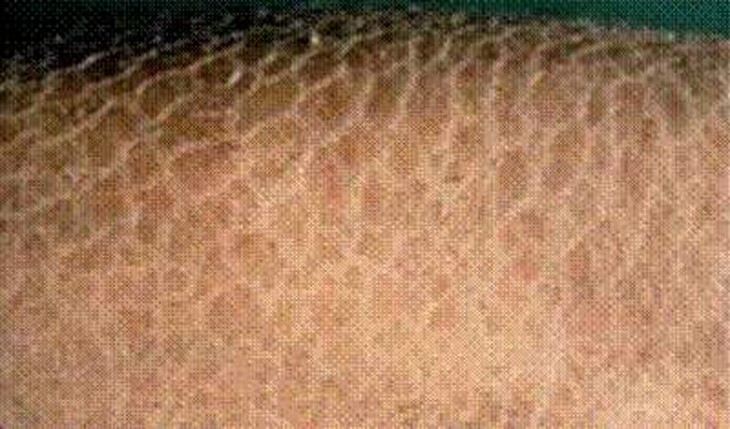 Bệnh vẩy cá có di truyền? 1