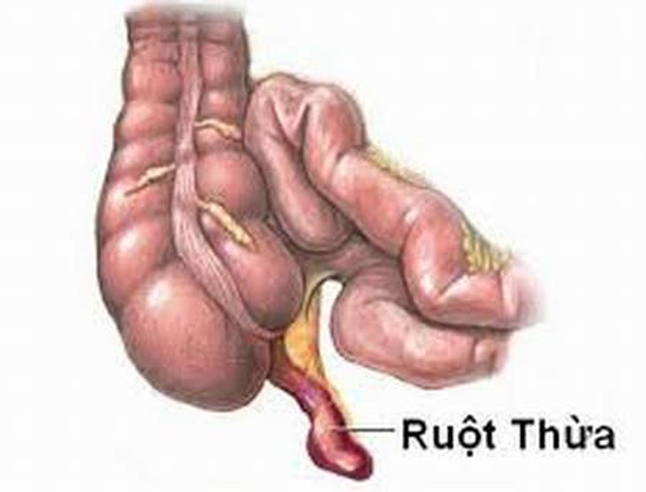 Coi chừng biến chứng viêm ruột thừa 2