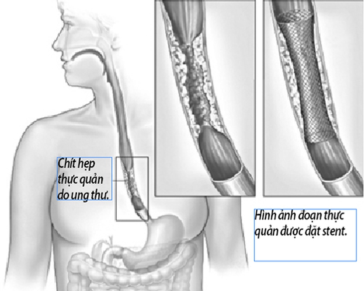 Đặt stent cho người ung thư thực quản giai đoạn cuối 1