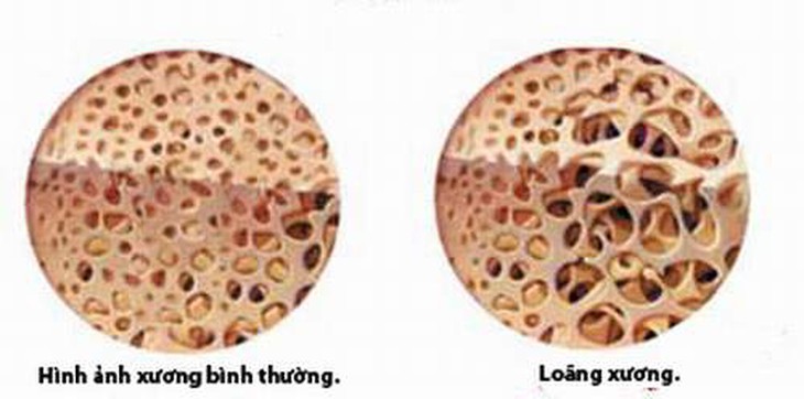 Phòng ngừa loãng xương sau mãn kinh 1