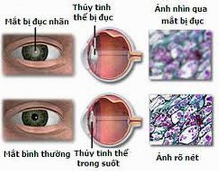 Statin có thể ngăn ngừa đục thủy tinh thể 1