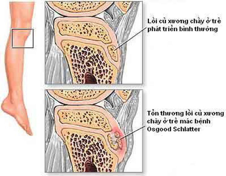 Đau đầu gối ở tuổi dậy thì - Bệnh gì? 1