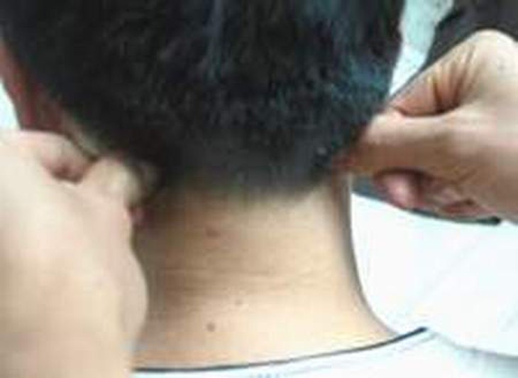 Day huyệt cải thiện tuần hoàn não  2