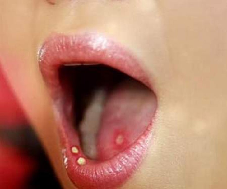Không chủ quan với viêm loét miệng lưỡi  1