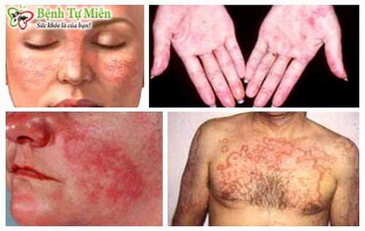 MM - Từ chống thải ghép tạng đến điều trị bệnh khớp tự miễn 1