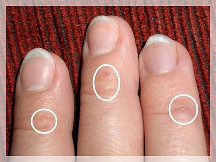 Đối phó với bệnh tổ đỉa 2