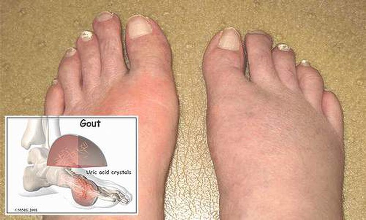 Colchicine và những lưu ý khi sử dụng điều trị gút 1