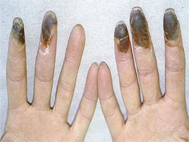Cụt chi vì hút thuốc lá 1