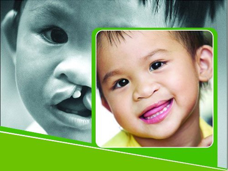 Khi nào nên mổ sứt môi hở hàm ếch? 1