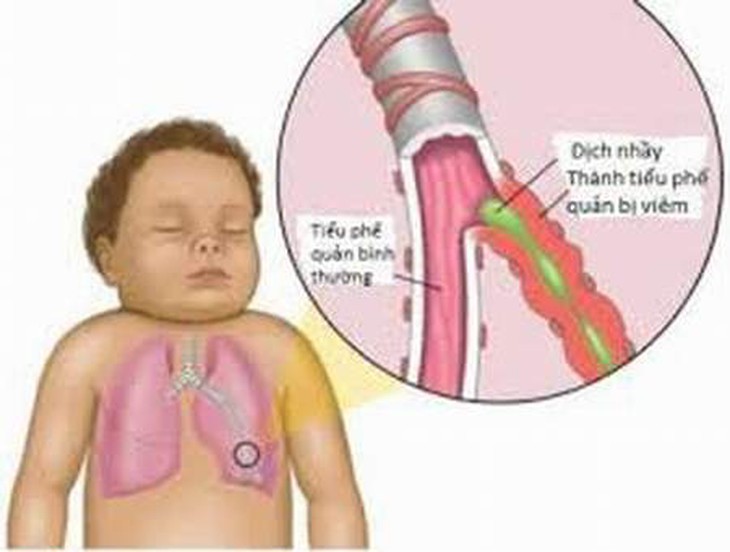 Nhận biết và phòng ngừa viêm tiểu phế quản ở trẻ 1