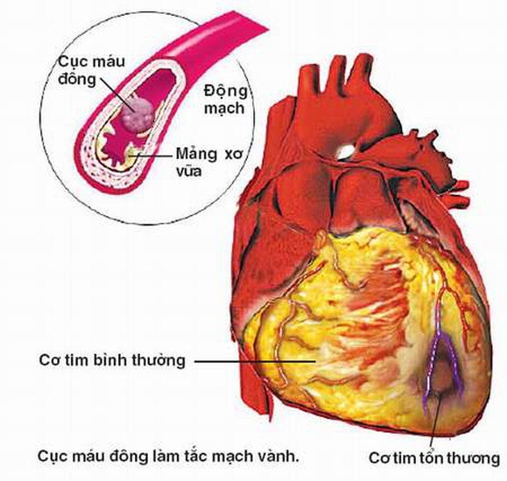 Nguyên nhân gây bệnh mạch vành 2