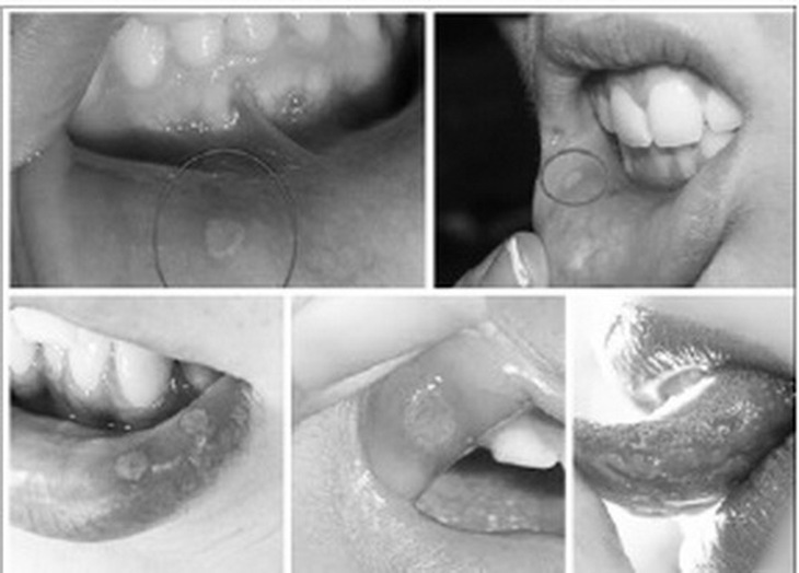 Tổn thương do loét miệng.
