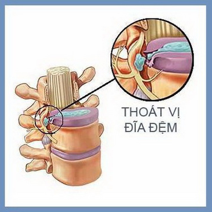 Thoát vị đĩa đệm có thể để lại những hậu quả và biến chứng nguy hiểm cho người bệnh.