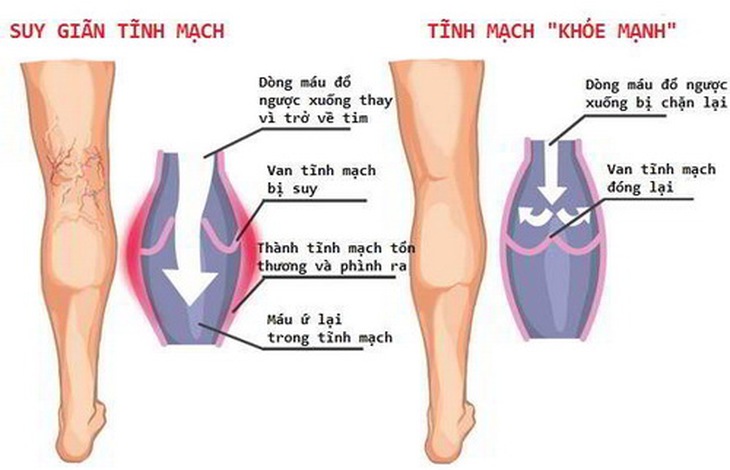 Hình ảnh giãn tĩnh mạch chi dưới.