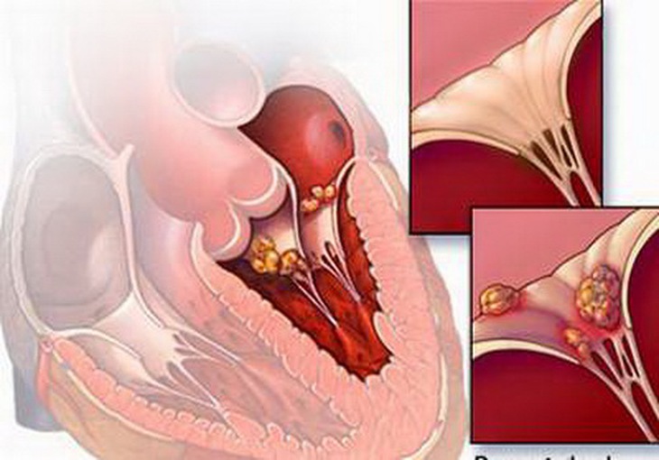 Hiểm họa từ viêm cơ tim