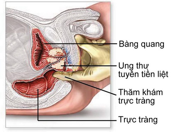 Ung thư tuyến tiền liệt có thể điều trị khỏi nếu được phát hiện sớm.