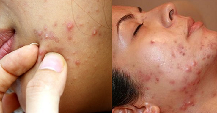 Mụn trứng cá gây đau và dễ để lại sẹo.