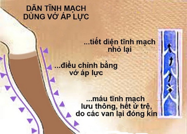 Điều trị giãn tĩnh mạch chân bằng vớ y khoa.