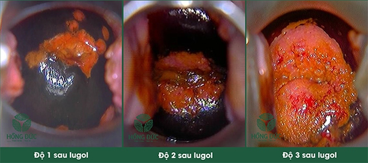 Các mức độ viêm lộ tuyến theo từng giai đoạn 1 – 2 – 3 (ảnh minh hoạ)