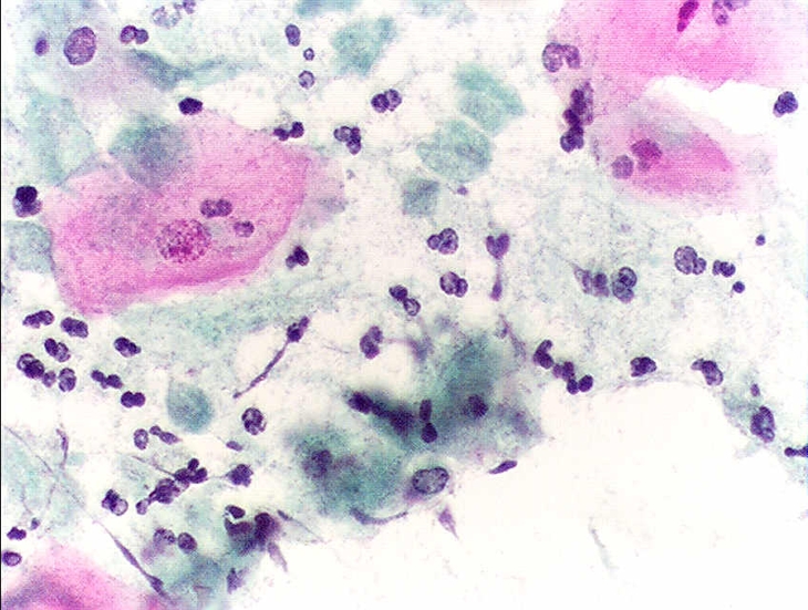 Trị viêm âm đạo do Trichomonas