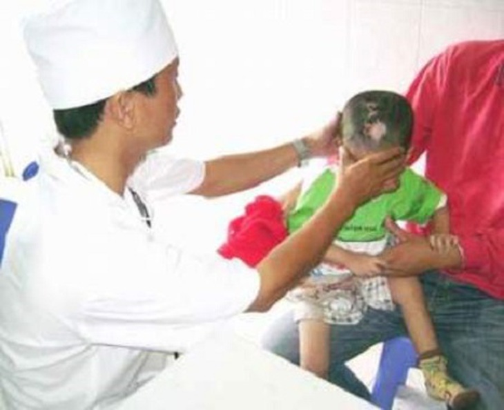 Phòng ngừa nhiễm trùng cơ hội bằng cotrimoxazol