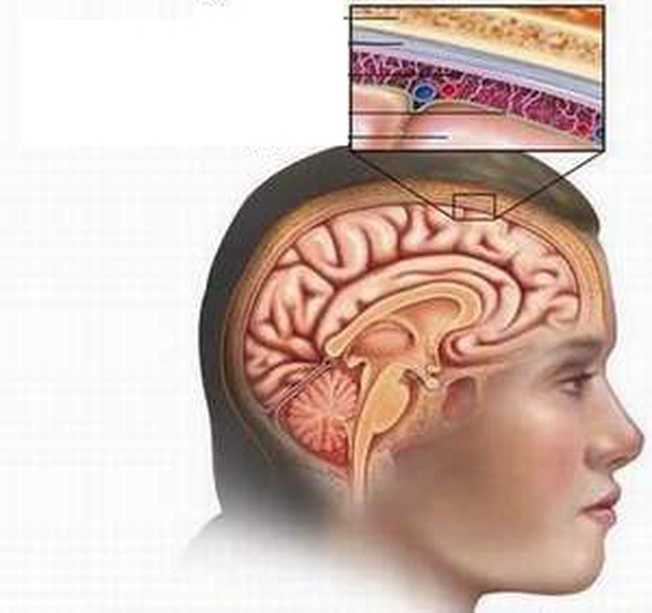 Nhận biết viêm màng não mô cầu