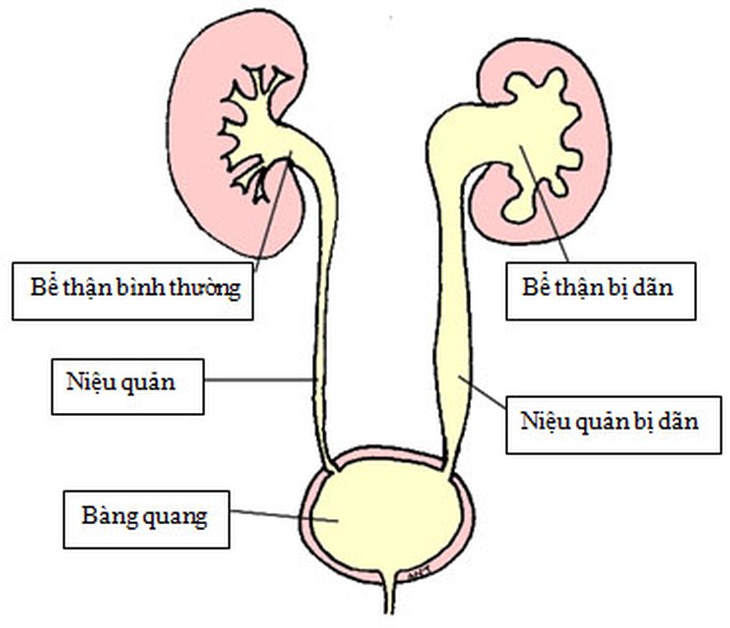 Thận ứ nước cần kiêng gì?