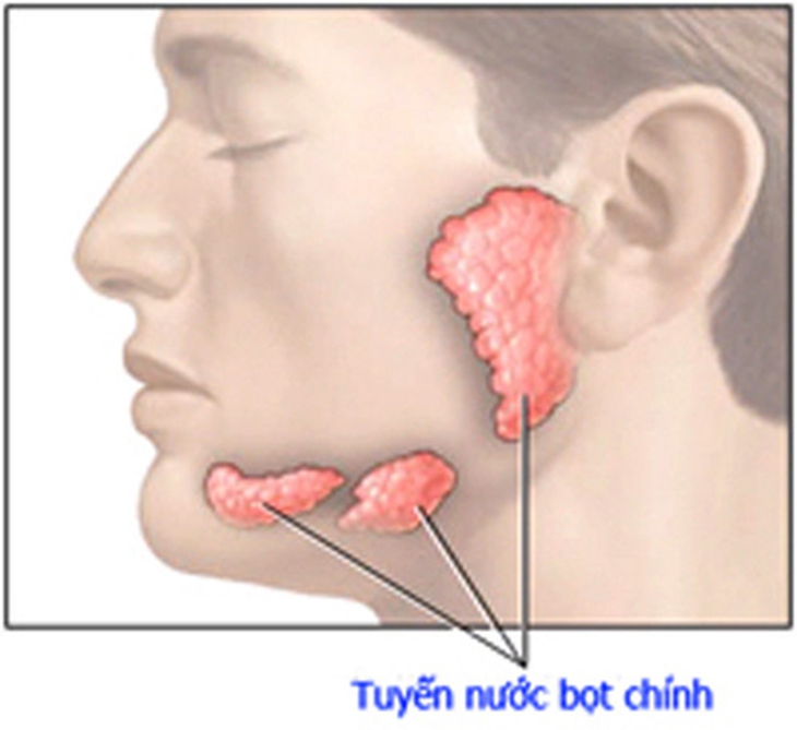 Sỏi tuyến nước bọt
