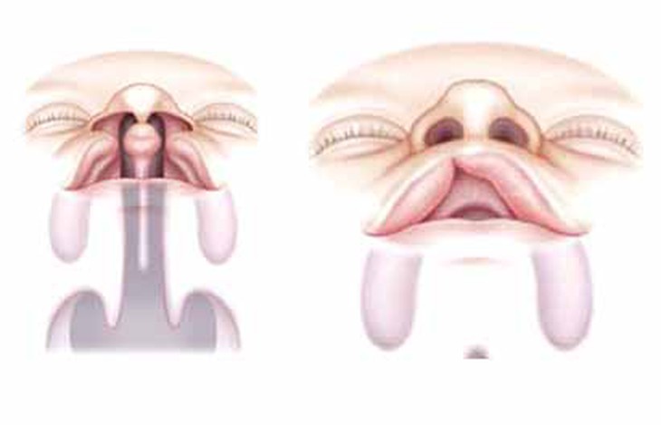 Chăm sóc răng miệng cho trẻ khe hở môi - vòm miệng