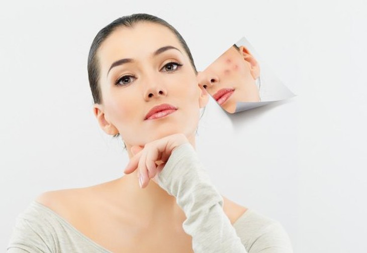 Bài thuốc Đông y chữa mụn trứng cá hiệu quả