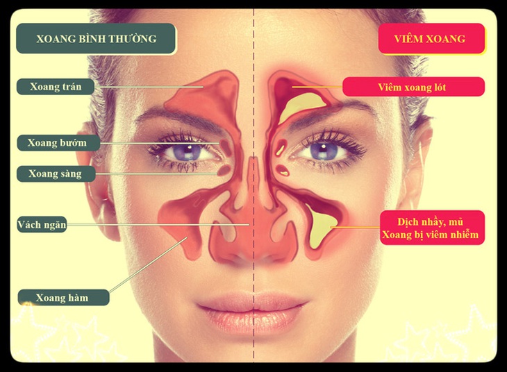 Các thuốc điều trị viêm xoang