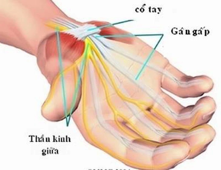 Hội chứng đường hầm cổ tay