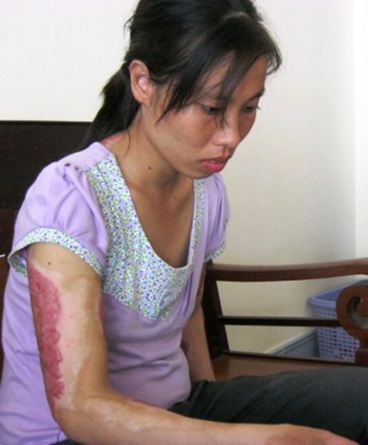 Bị chồng tưới xăng đốt, vợ vẫn viết đơn xin khoan hồng