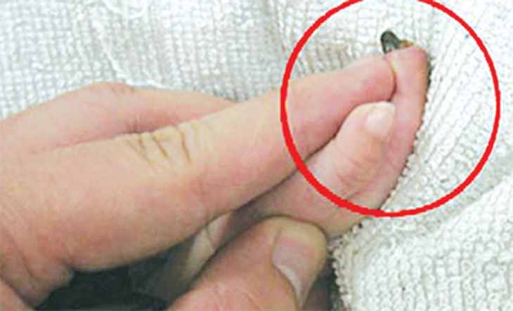 Thuốc corticoid: lợi và hại