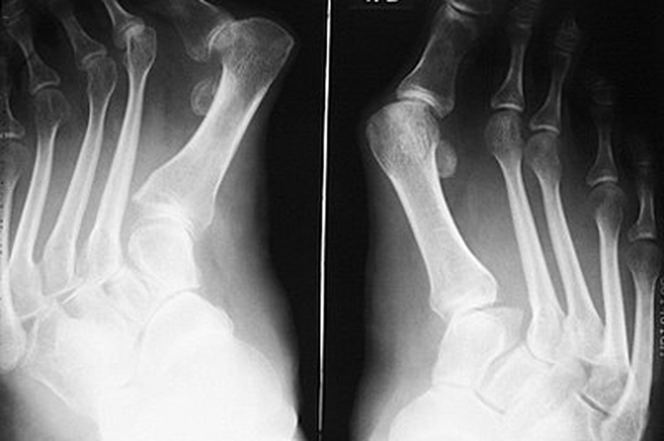 Thế nào là hội chứng Ehlers-Danlos? 