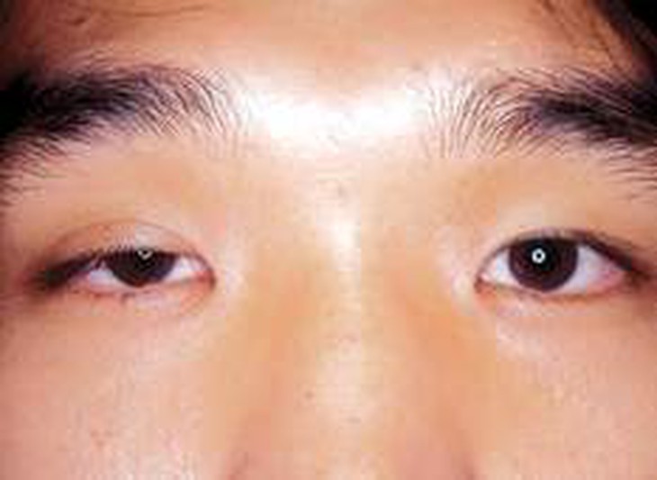 Sụp mi bẩm sinh có điều trị khỏi?     
