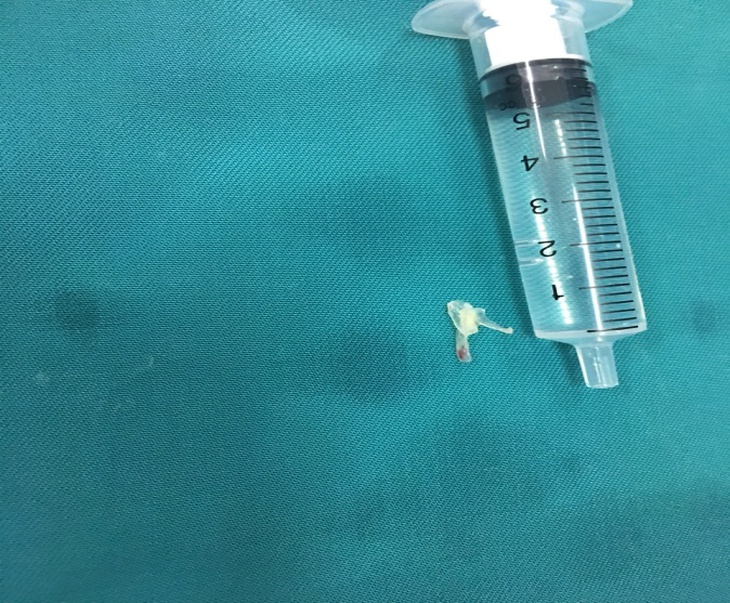 Hình ảnh mảnh xương được gắp ra từ đường thở của bệnh nhân