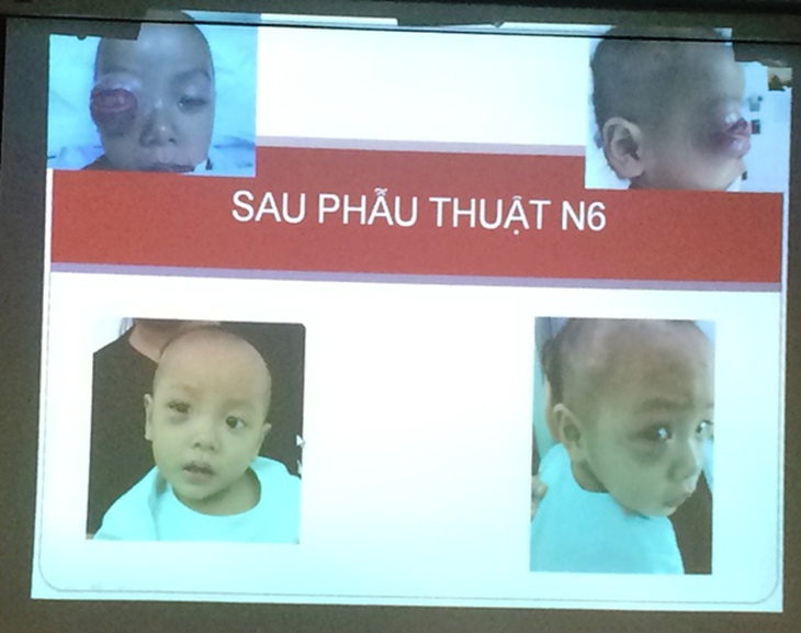 Kết quả trước và sau mổ