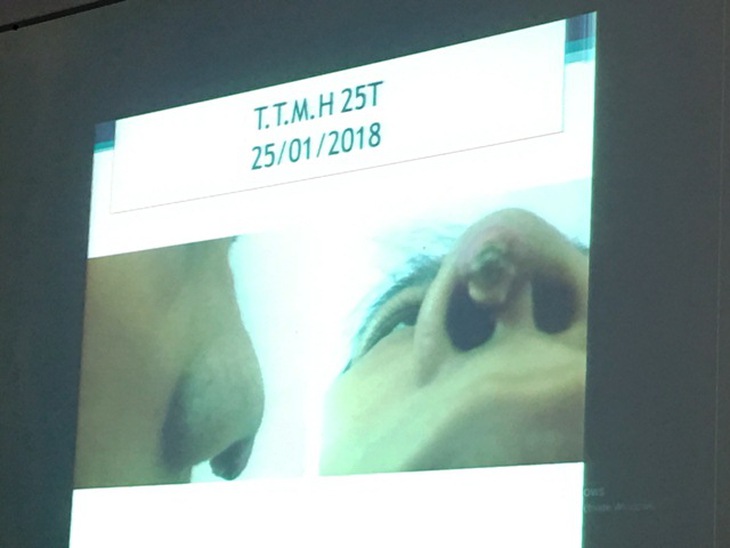 Một ca biến chứng do nâng mũi ở tiệm uốn tóc vừa nhập vào khoa Bỏng - Tạo hình Thẩm mỹ (BV Trưng Vương)