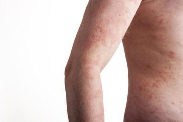viem da di ung eczema