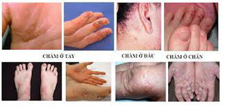 Biểu hiện bệnh chàm ở trên cơ thể
