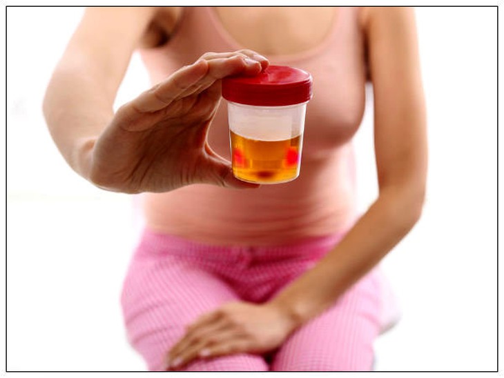  cục máu đông trong nước tiểu