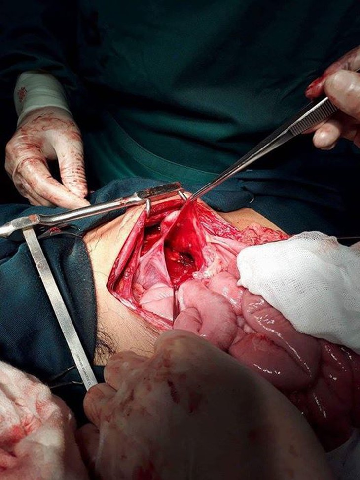 Cứu sống nạn nhân nặng do dao đâm xuyên thấu bụng