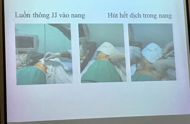 Kỹ thuật điều trị nang thận không phẫu thuật