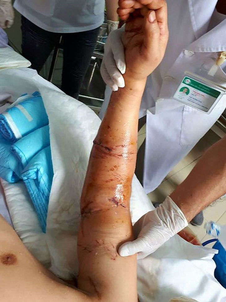 Cánh tay sau khi được nối liền