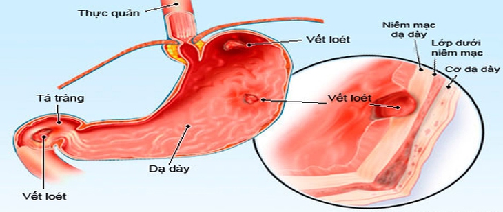 bệnh dạ dày