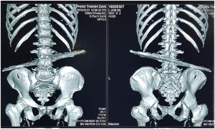 cứu sống bệnh nhân bị cọc sắt đâm xuyên bụng